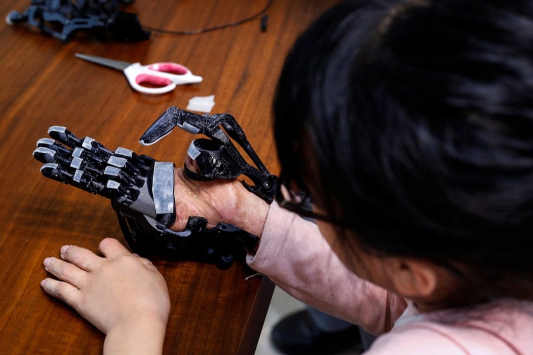 Angel的媽媽說她買不起昂貴的義肢。