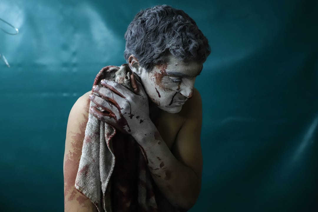 2018年3月13日，敘利亞大馬士革，一名受了傷的敘利亞男子在市郊的一所臨時診所等候治療。