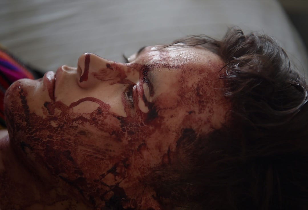 2018年3月21日，阿富汗一名自杀式炸弹袭击伤者在医院接受治疗。爆炸发生在喀布尔西部一条通往逊尼派清真寺路上，民众当时正庆祝波斯新年，炸弹造成最少26死，ISIS其后承认责任。