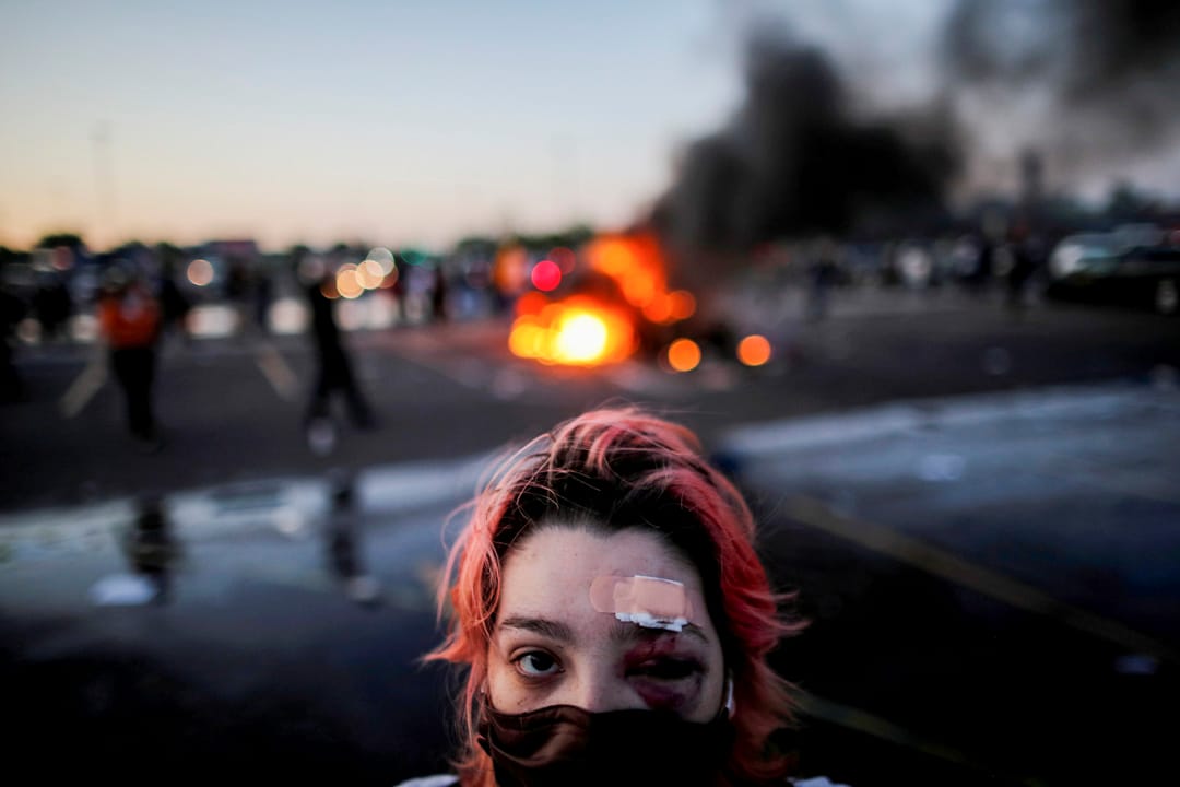 2020年5月28日美国明尼苏达州阿波利斯市，一名示威者眼部被橡胶子弹击伤。