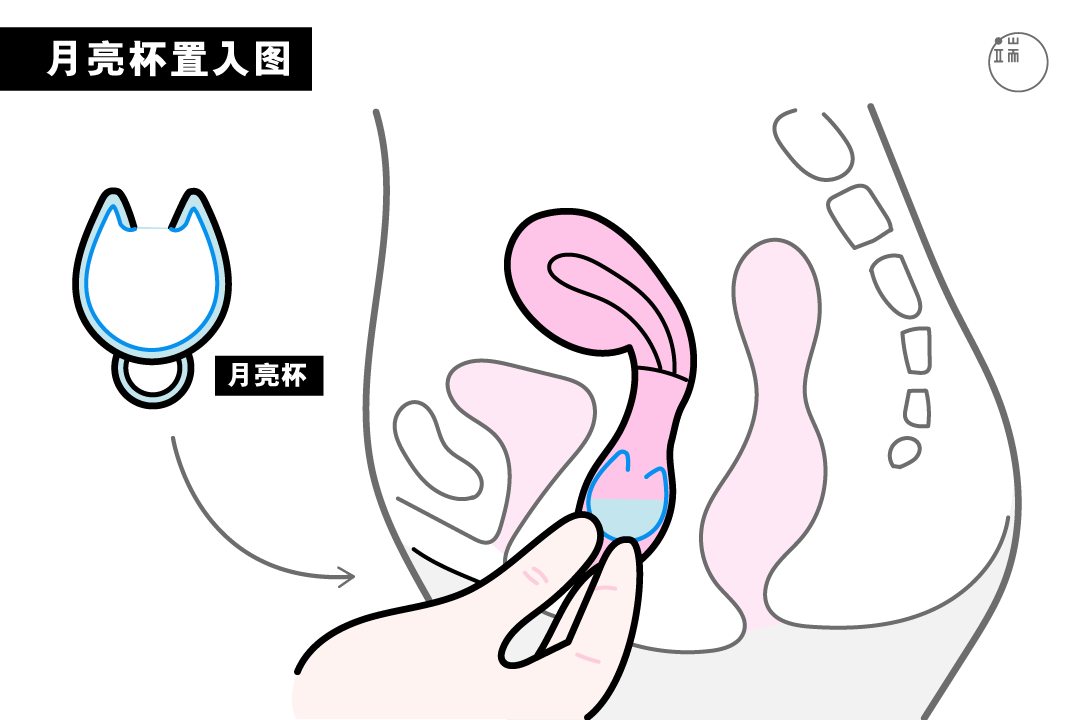 月亮杯置入图